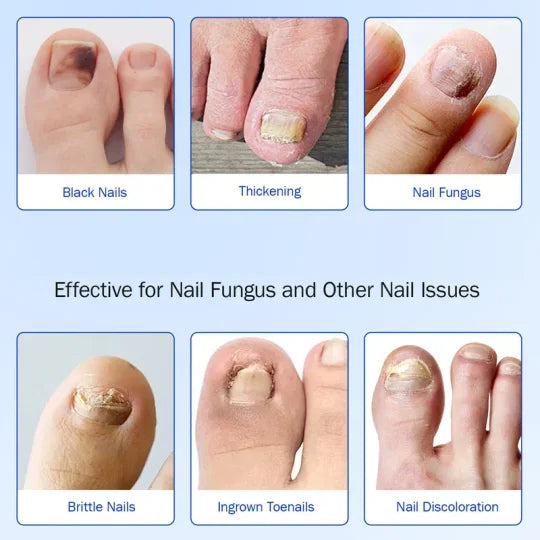 Fungal Nail Patches